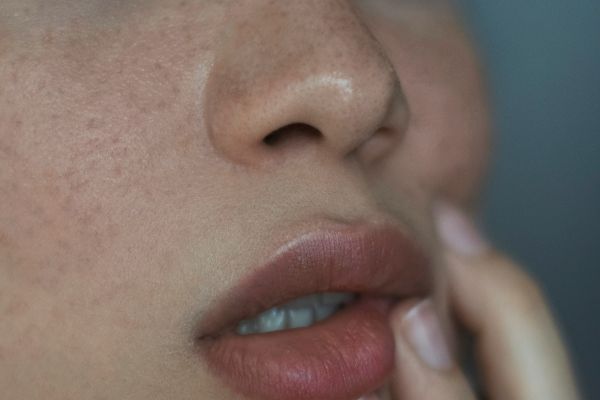 How to Remove Dark Spots Naturally on Face
